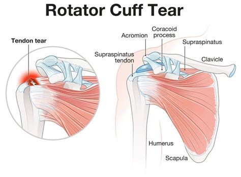 what test for rotator cuff tear|how do i know if need rotator cuff surgery.